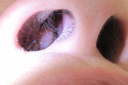Treatment of Nasal Polyps