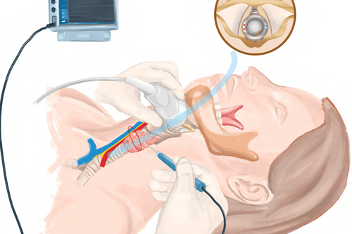Treatment of Vocal Cord Nodules