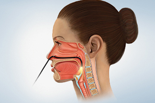 Fiberoptic Endoscopic Evaluation of Swallowing (FEES)