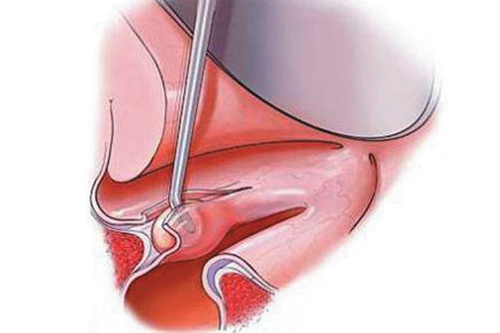 Phonosurgery