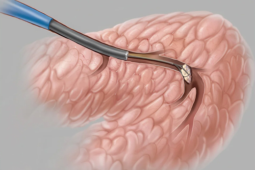 Salivary Gland Surgery