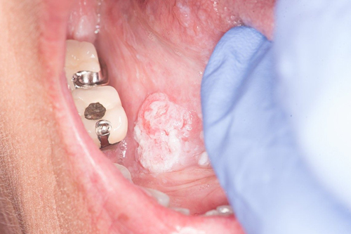 Oral Cavity Tumor/Cancer Surgery