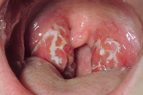 Tonsillitis and Adenoid Disorders
