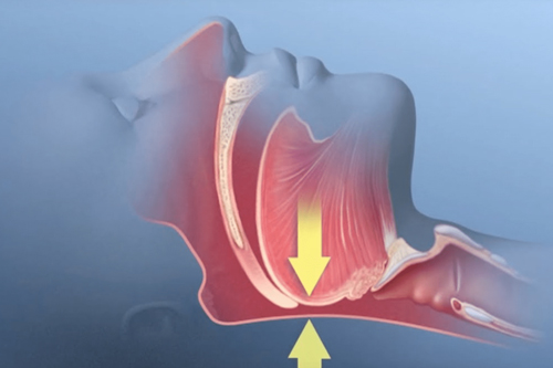 Diagnosis and Management of Obstructive Sleep Apnea (OSA)