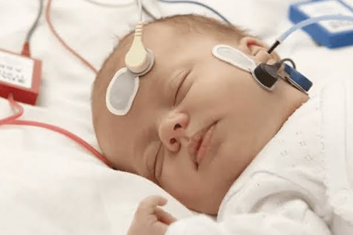 Brainstem Evoked Response Audiometry (BERA)