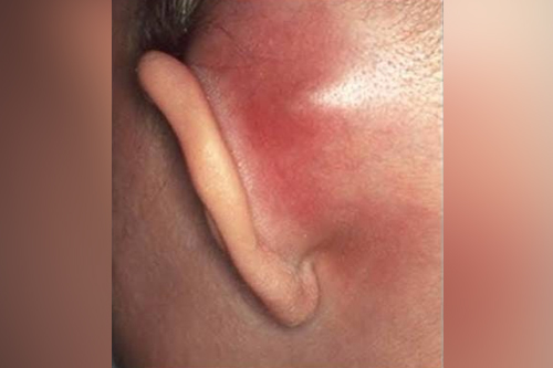 Incision & Drainage of Abscesses