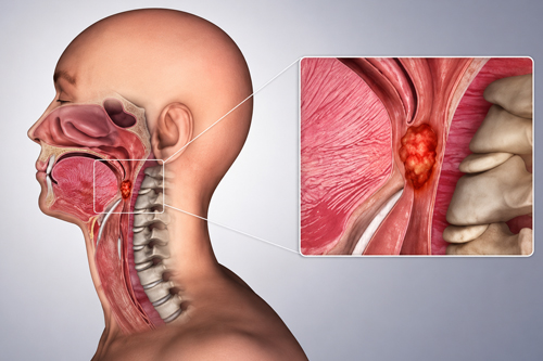 Head & Neck Cancer Diagnosis & Biopsy